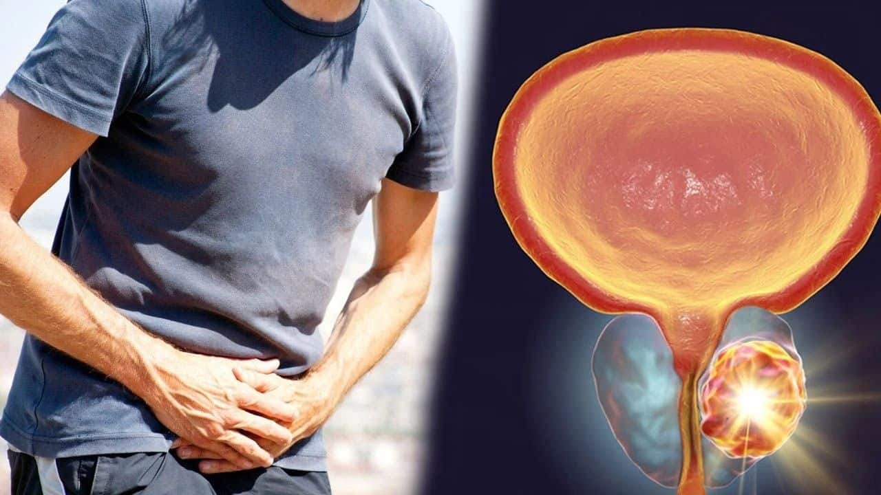 Prostat Kanserinde Yeni Umut: Lutesyum-177 PSMA Tedavisinin Yenilikçi Yaklaşımı