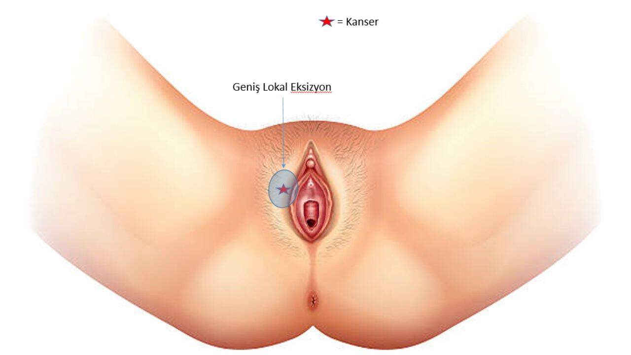 Vulva Kanseri: Kadınlarda Sık Görülen Bir Jinekolojik Kanser