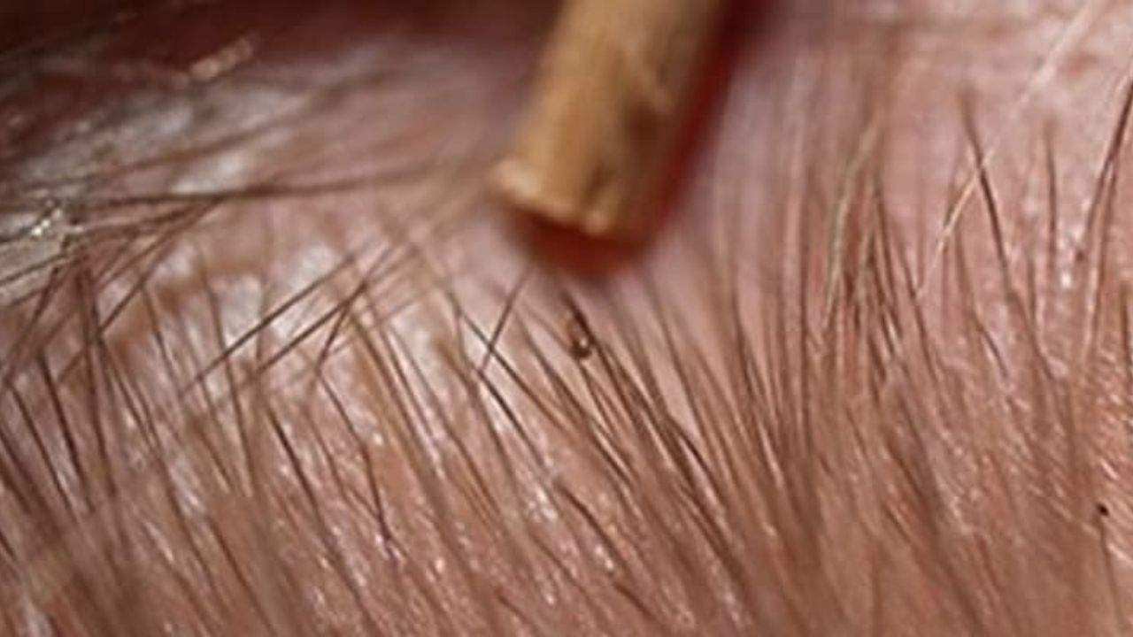 Bitlenme: Nedir, Belirtileri ve Tedavi Yöntemleri