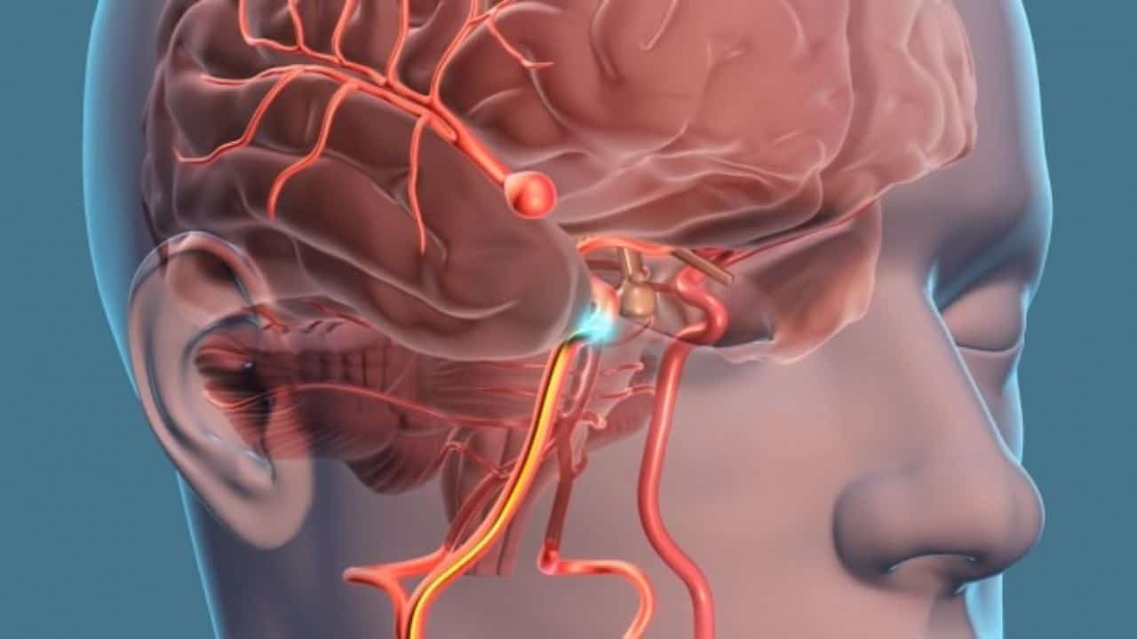 Aneurizma Nedir? Belirtileri, Nedenleri ve Tedavi Yöntemleri