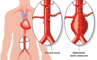 Aort Anevrizması Nedir? Belirtileri ve Tedavi Yöntemleri Nelerdir?