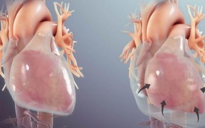 Perikardit Nedir? Belirtileri, Nedenleri ve Tedavi Yolları