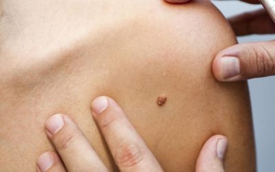 Seboreik Keratoz Tedavi Yöntemleri: Cerrahi ve Alternatif Seçenekler