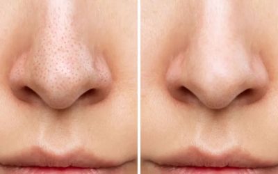 Burnunuzdaki Siyah Noktalara Müdahale Etmeyin! Dermatologlardan Kritik Uyarı: “Büyük Hata Yapıyorsunuz”