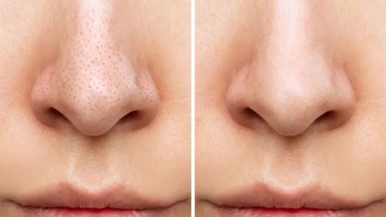 Burnunuzdaki Siyah Noktalara Müdahale Etmeyin! Dermatologlardan Kritik Uyarı Büyük Hata Yapıyorsunuz