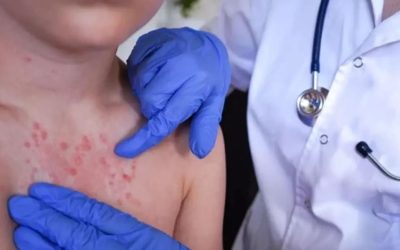 Uyuz vakaları kışın zirve yapıyor: Belirtiler 2 haftada ortaya çıkıyor, tedavi edilmezse 3 yıl sürebiliyor