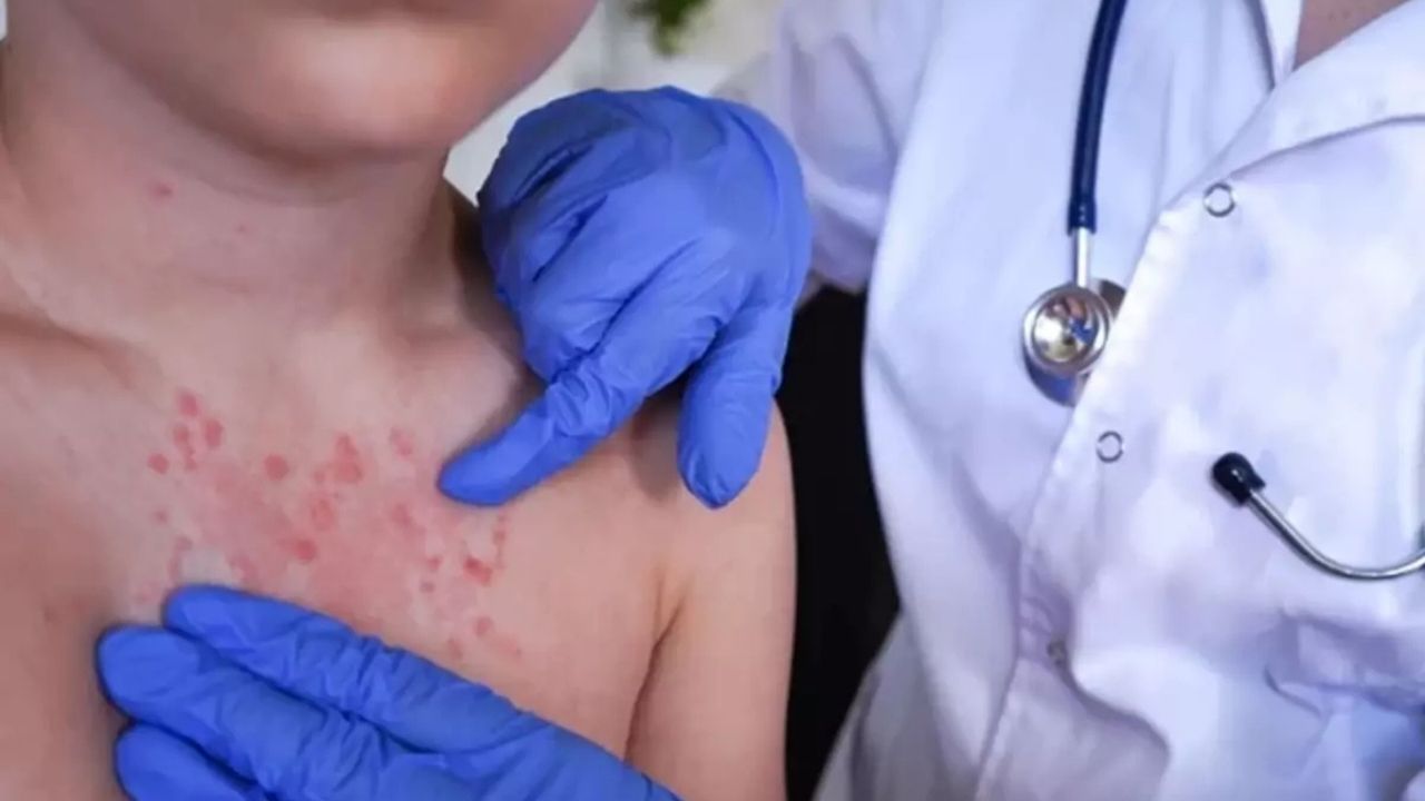 Uyuz vakaları kışın zirve yapıyor Belirtiler 2 haftada ortaya çıkıyor, tedavi edilmezse 3 yıl sürebiliyor